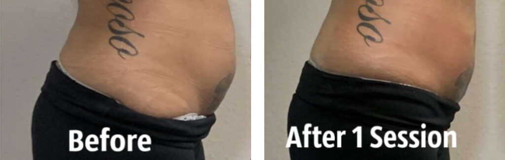 body sculpting orange ca before and after 1 session